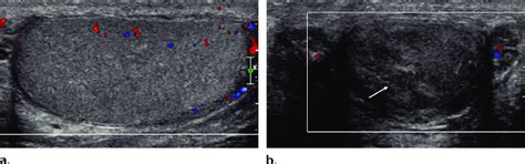 Testicular Atrophy In A 25 Year Old Man With A History Of Previous