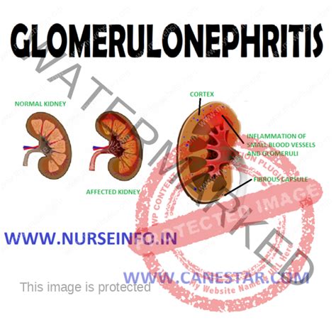 Glomerulonephritis Nurse Info