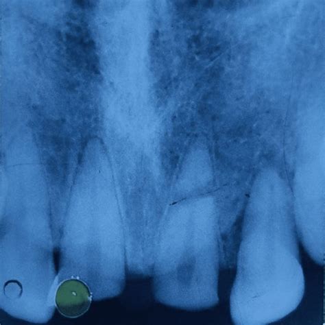 Preoperative Radiograph Showing Horizontal Root Fracture At The