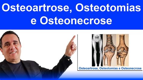 Osteoartrose Osteotomias E Osteonecrose Youtube