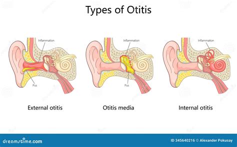 Otitis Healthy Membrane And Bulging Tympanic Membrane Of Acute Otitis