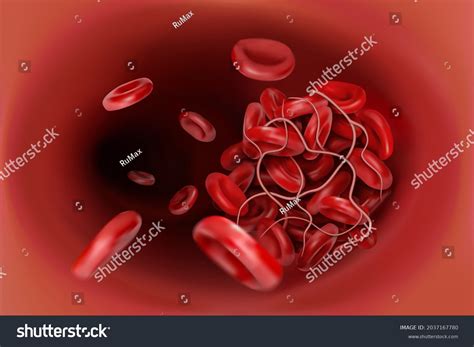 혈전: 3,087개가 넘는 로열티 프리 라이선스 대상 스톡 일러스트 및 그림 | Shutterstock