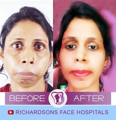 Jaw Surgery Richardsons Plastic Surgery Hospitals