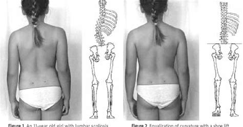 Figure 1 From Functional Scoliosis Caused By Leg Length Discrepancy