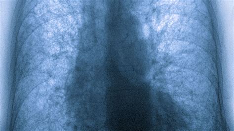 Healthy Lungs Vs Smokers Lungs X Ray