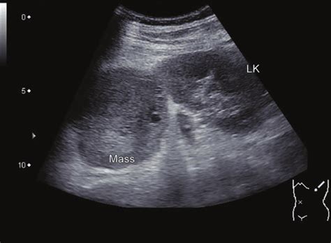 Renal Mass Ultrasound