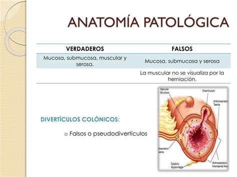 Ppt Enfermedad Diverticular Powerpoint Presentation Id 4011364