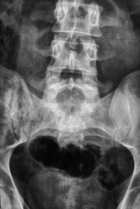 Normal Sacroiliac Joint X Ray