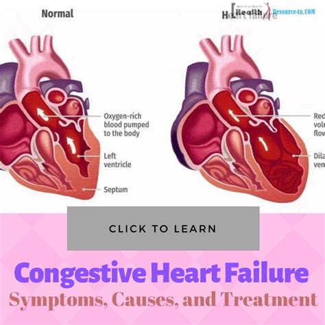 Congestive Heart Failure : Symptoms, Causes, And Treatment