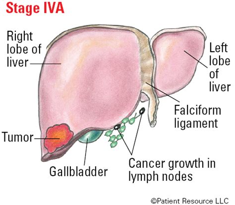 Liver Cancer Staging Systems