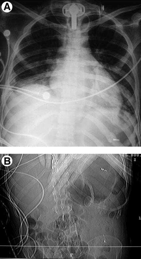 Application Of Intermaxillary Fixation Screws In Maxillofacial Trauma