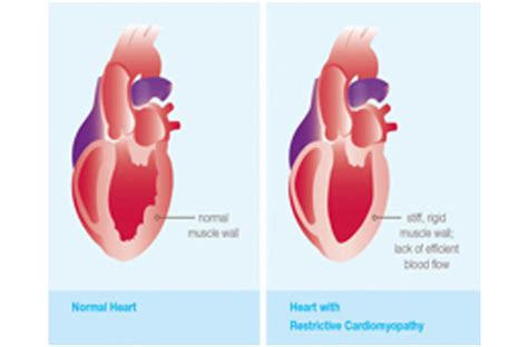 Rcm Restrictive Cardiomyopathy