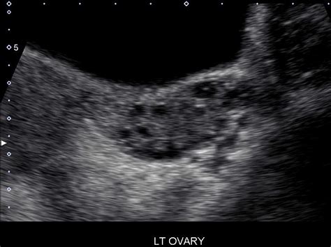 PCOS, Hypothalamic Amenorrhea, or Both? - PCOS Nutrition Center