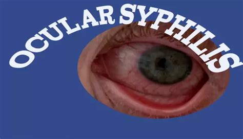 Ocular Syphilis: Causes, Signs, Treatment Methods – EYExan.com