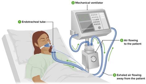 Ventila O Mec Nica Invasiva Concise Medical Knowledge