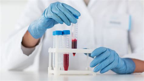 Cancer Blood Test Could Help Early Diagnosis Of Pancreatic Cancer