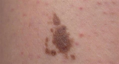 ¿qué Son Las Manchas Solares En La Piel