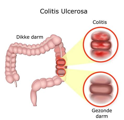 Colitis Ulcerosa Colitis Ulcerosa Oorzaak Colitis Ulcerosa Behandeling