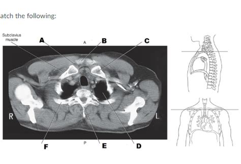 Axial-CT-of-Superior-thoracic-aperture Diagram | Quizlet