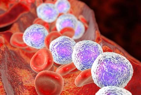 Risk For Cancer Increased For Relatives Of Patients With Leukemia