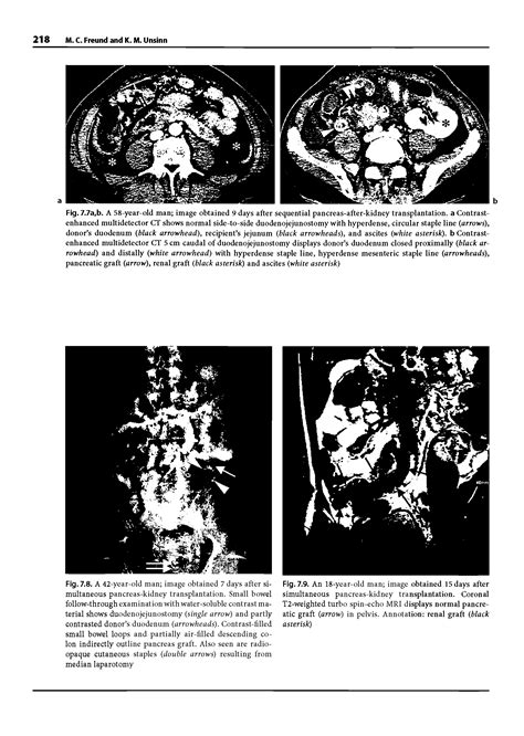 Pancreas-kidney transplantation - Big Chemical Encyclopedia