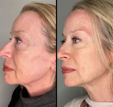 Pdo Thread Lift Before And After Jowls At Violet Woodman Blog