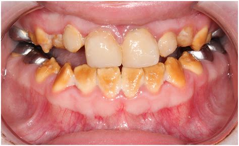 Retrospective Study Of Patients With Amelogenesis Imperfecta Treated