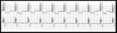 Practice EKG Strips 345