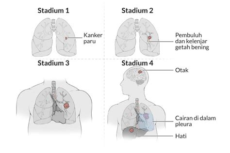 Diagnosis Kanker Paru Paru Alodokter