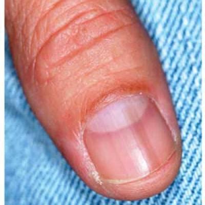 Melanoma Under Nail Bed Photos Bios Pics