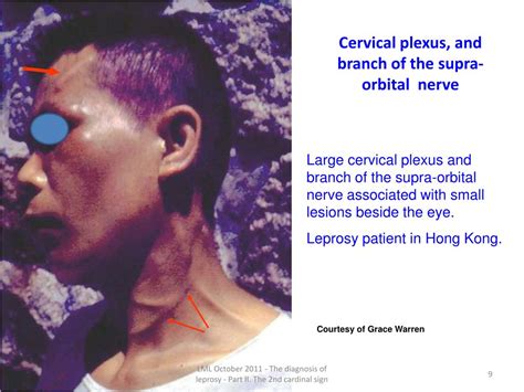 Ppt The Diagnosis Of Leprosy Part Ii The 2 Nd Cardinal Signs Of