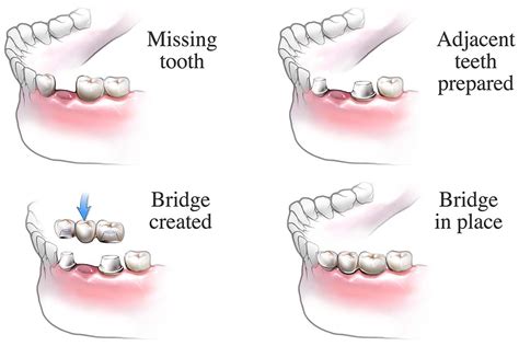 dental bridge procedure