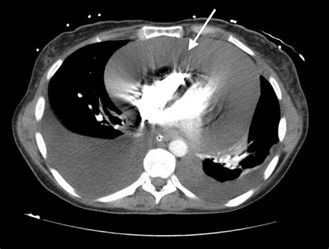 A Case Of Primary Lung Adenocarcinoma With Two Uncommon Presentations Neurological