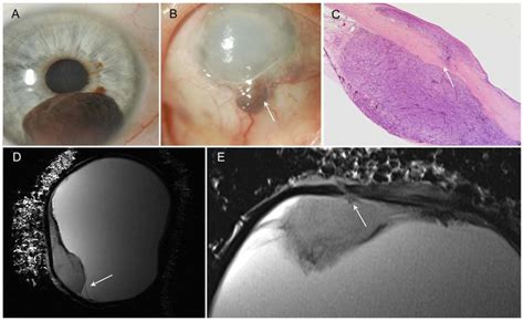 Malignant Melanoma Of Iris And Ciliary Body With Scleral Perforation