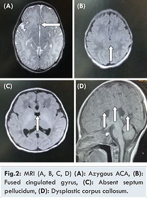 Holoprosencephaly Brain