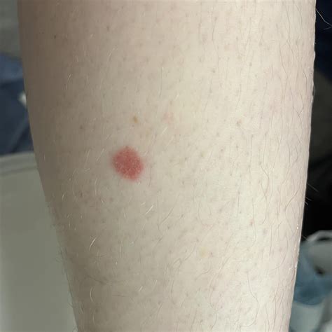 Raised red bump on calf, skin cancer survivor : r/AskDocs