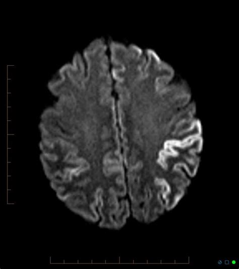 Creutzfeldt Jakob Disease Neurology Medbullets Step 2 3