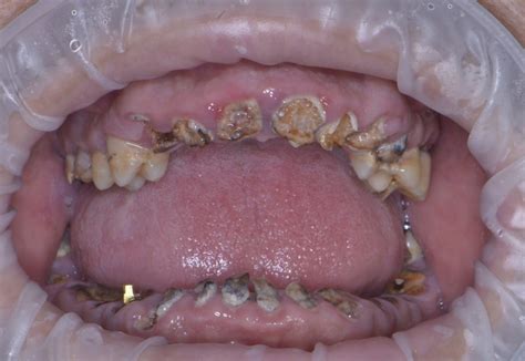 Імплантація ВСЕ-НА-4 - Зуби за 1 день* - SmartDent