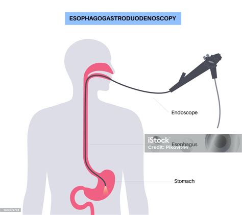 Gastroscopy Endoscopy Procedure Stock Illustration Download Image Now