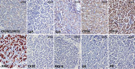 Metastasis From Small Cell Lung Cancer To Ovary A Case Report