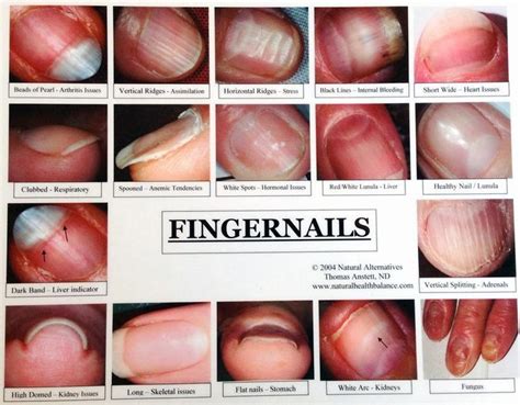 Fingernail Health Signs