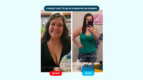 Ozempic For Weight Loss Reviews Before And After Photos Via Radiology