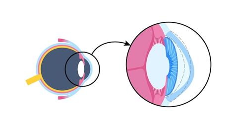 Premium Vector Cataract Eye Disease