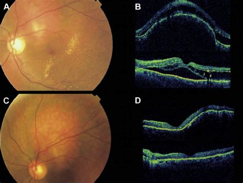 E Ophthalmoscopic Appearance Of Choroidal Hemangioma Before And After