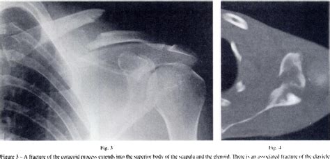 [pdf] Fractures Of The Coracoid Process Semantic Scholar