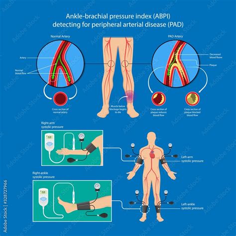 Peripheral Artery Disease Ankle Brachial Index ABI Test Limb Ischemia