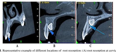 Figure 1 From Location Of External Root Resorption Of Upper Permanent