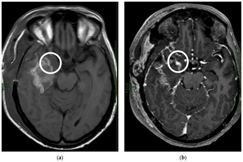 Tomography Free Full Text T1 Weighted Contrast Enhancement