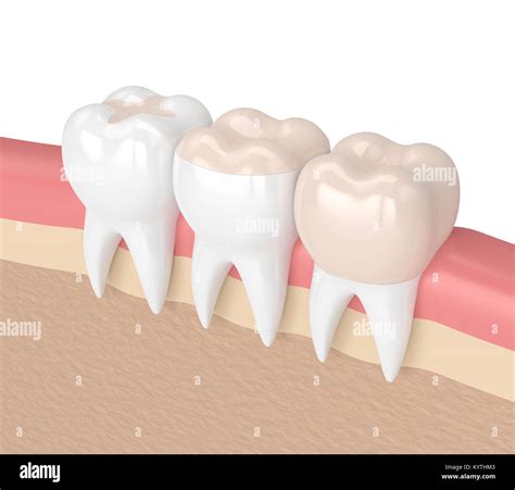 D Render Of Teeth With Inlay Onlay And Crown Filling In Gums Stock