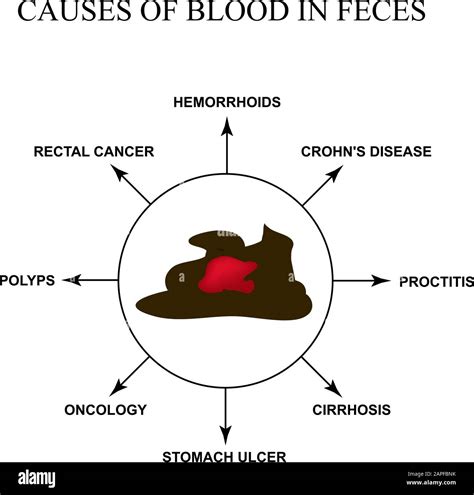 Causas De La Sangre En Las Heces Enfermedades Del Tracto